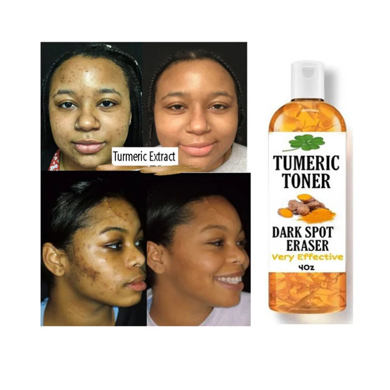 100ml Tumeric Dark Spots Toner Spots Eraser Corrector Turmeric Fades Blemishes Dark Spots Acne Remover Toner