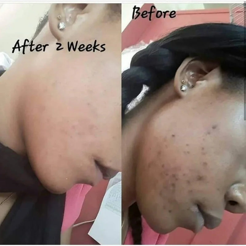 100ml Tumeric Dark Spots Toner Spots Eraser Corrector Turmeric Fades Blemishes Dark Spots Acne Remover Toner