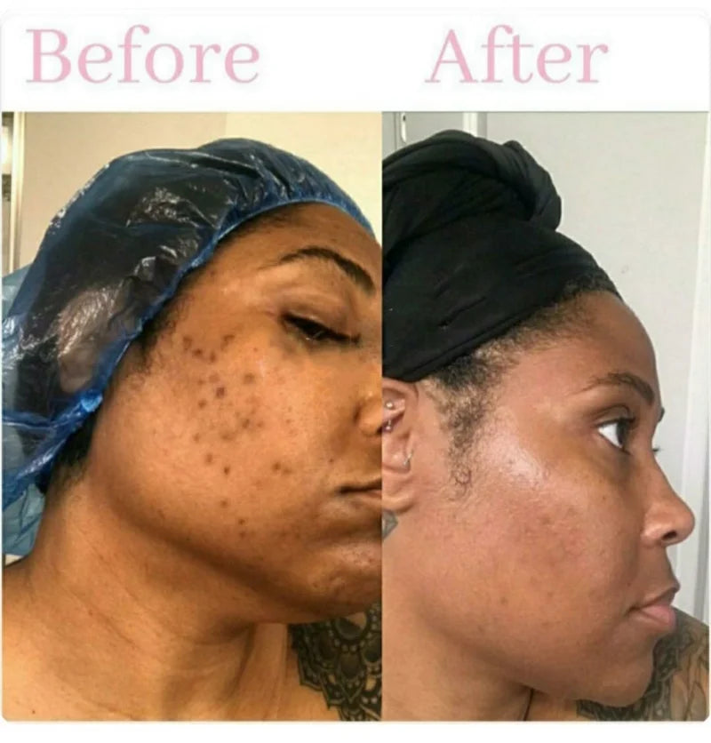 100ml Tumeric Dark Spots Toner Spots Eraser Corrector Turmeric Fades Blemishes Dark Spots Acne Remover Toner