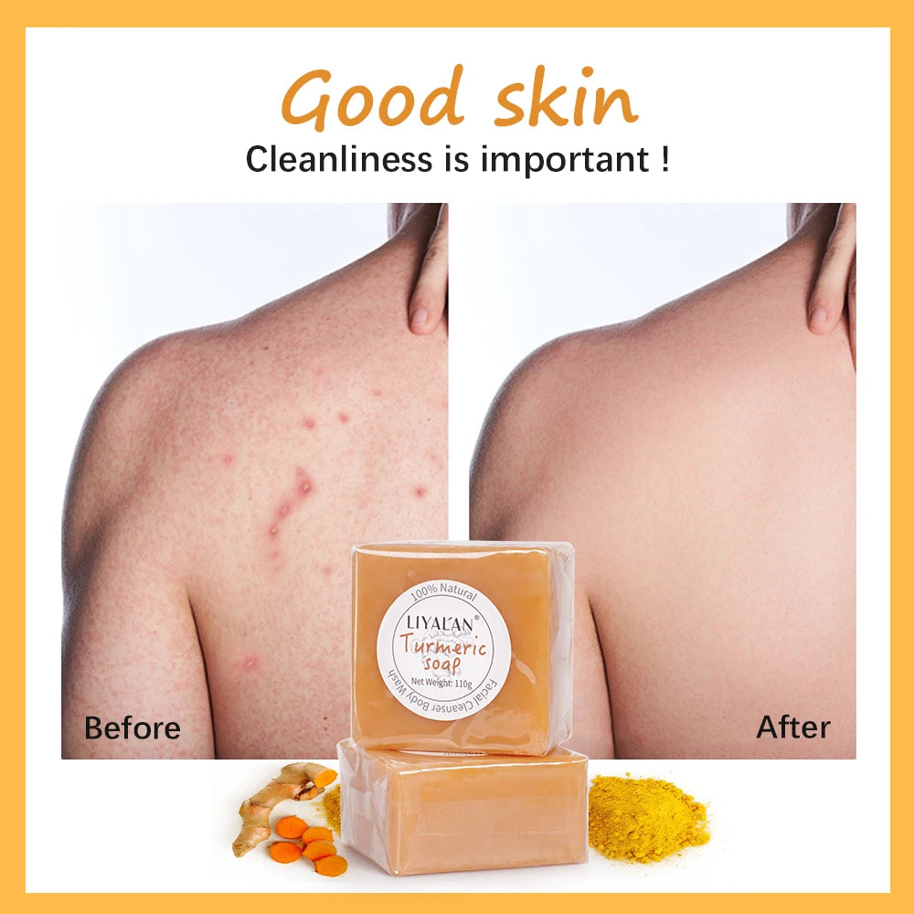 LIYALAN Turmeric Face Soap Acne Treatment  Dark Spot Correcting Moisturizing Handmade Bath Soap